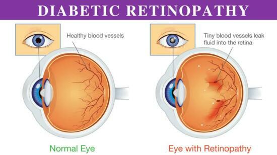 Diabetic Retinopathy