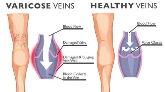 Varicose Vein - What Are They?