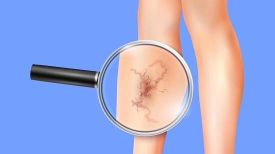 Symptoms and Complications of Varicose Veins