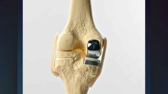 What Is Partial Knee Replacement? | Explained by Dr Jaimin Vaishnav