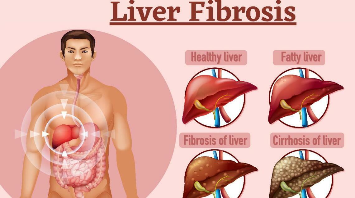 Fibrosis of the Liver