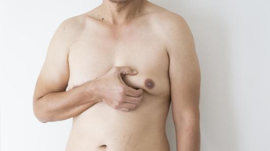 Gynecomastia Surgery