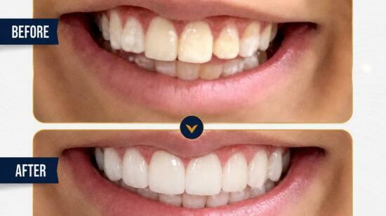 Transforming Smile Boosting Confidence.