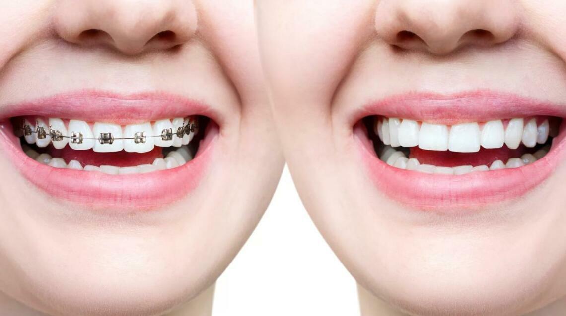 Aligners or Braces ? What Is Perfect for My Child