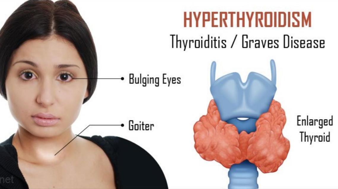 All About Hyperthyroidism