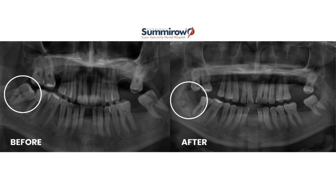 Extraction of Infected Impacted Wisdom Tooth (48)