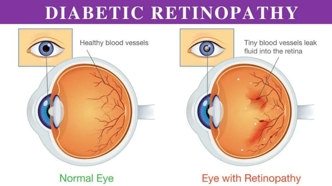 Diabetic Retinopathy