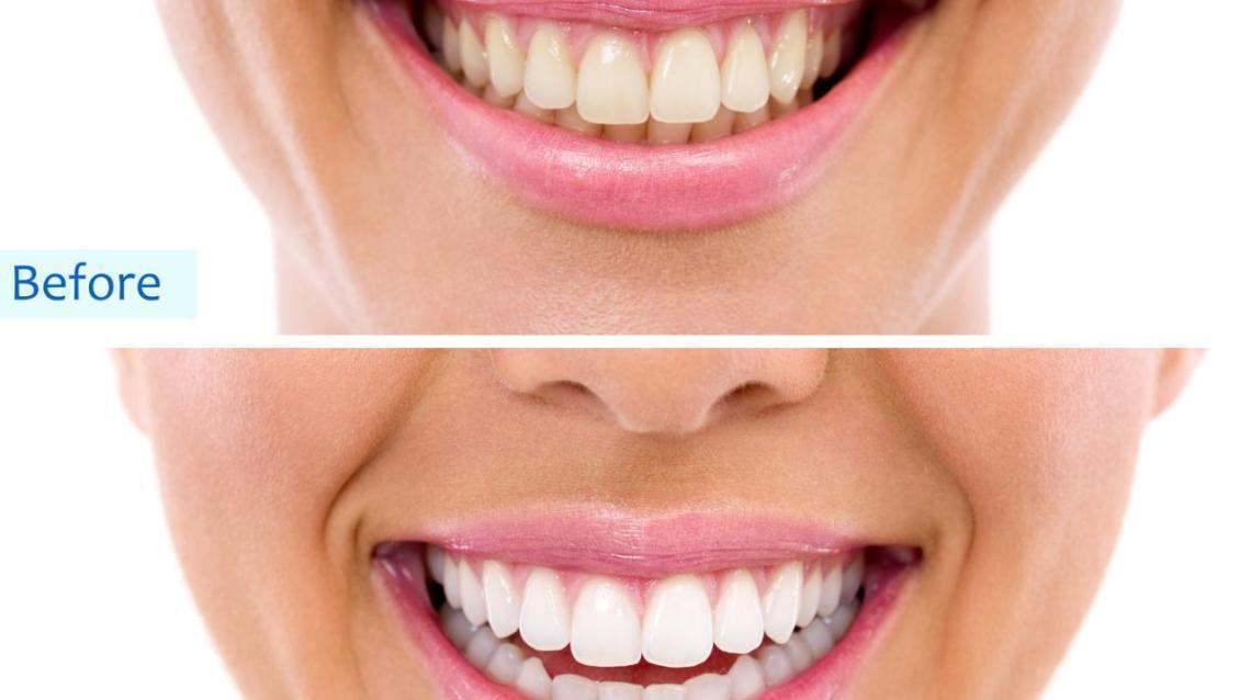 Teeth Whitening Treatment Cost In Bangalore TeethWalls