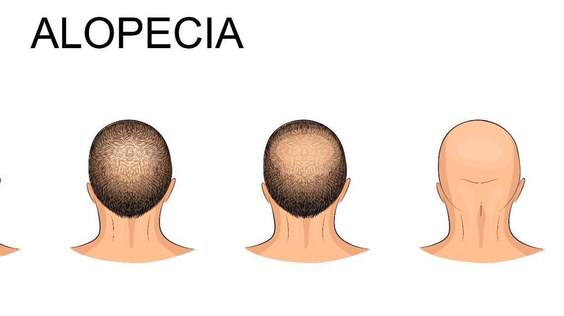 Male Pattern Baldness Alopecia Four Early Warning Signs