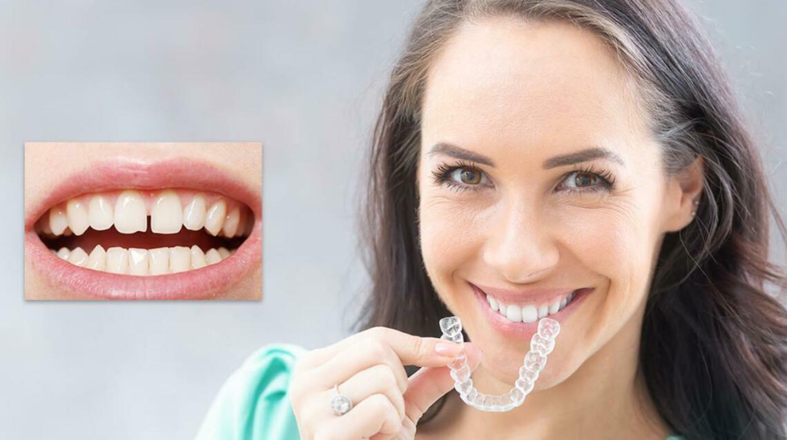 Can Invisalign Clear Aligners Help With Gaps Between Teeth?