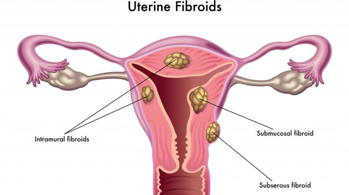 Fibroids In Utrus Bulky Utrus With Few Small Intra Mural Practo Consult