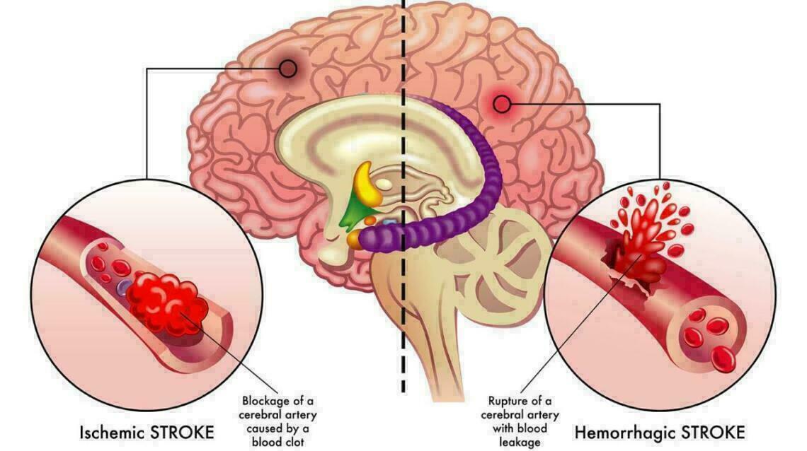7 Early Warning Signs of Stroke You Should Never Ignore