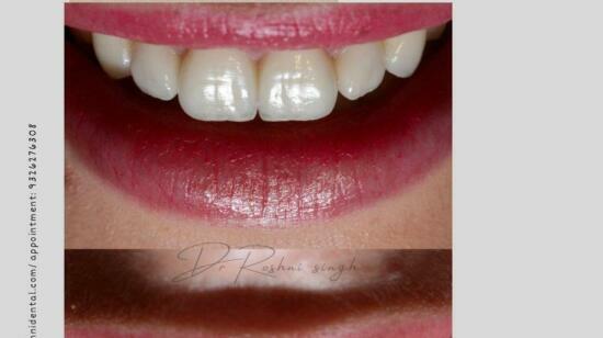 Laser Sculpted Smile: Precesion Meets Perfection