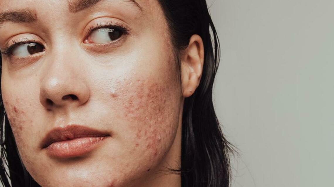 Why Dermatologist-Led Care Is the Smartest Way to Manage Acne
