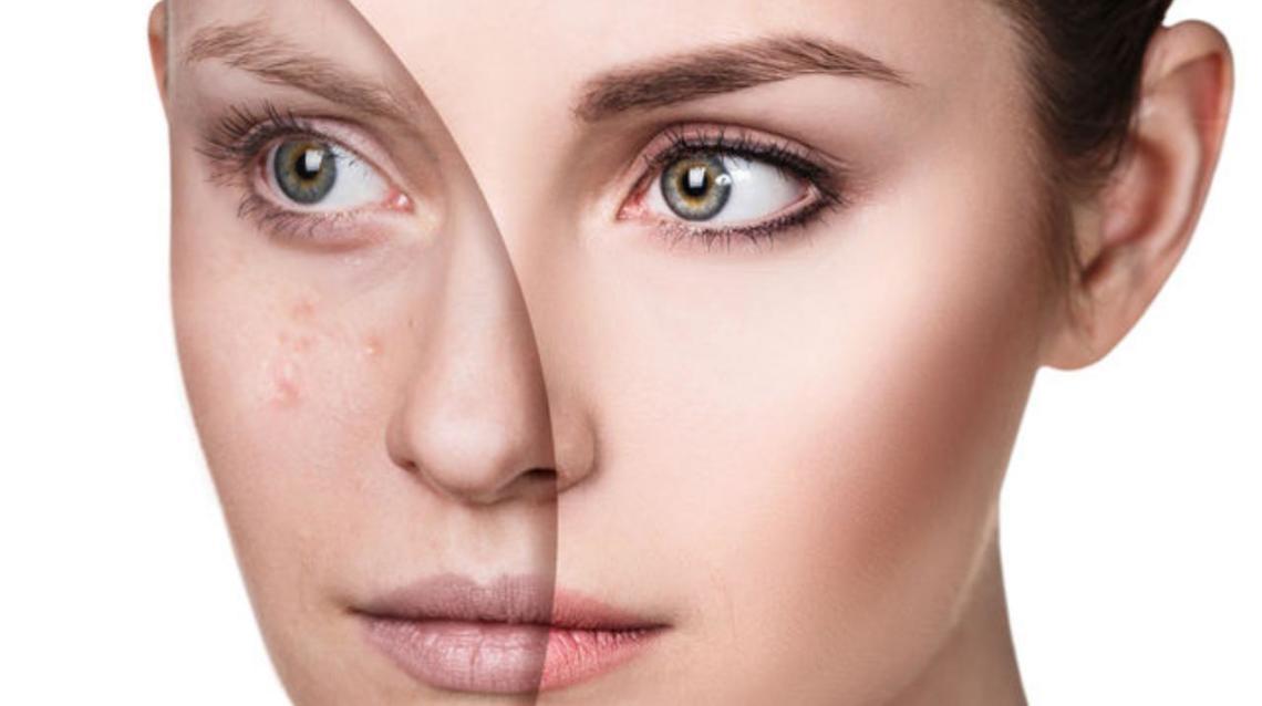 3 Powerful Home Remedies for Hormonal Acne