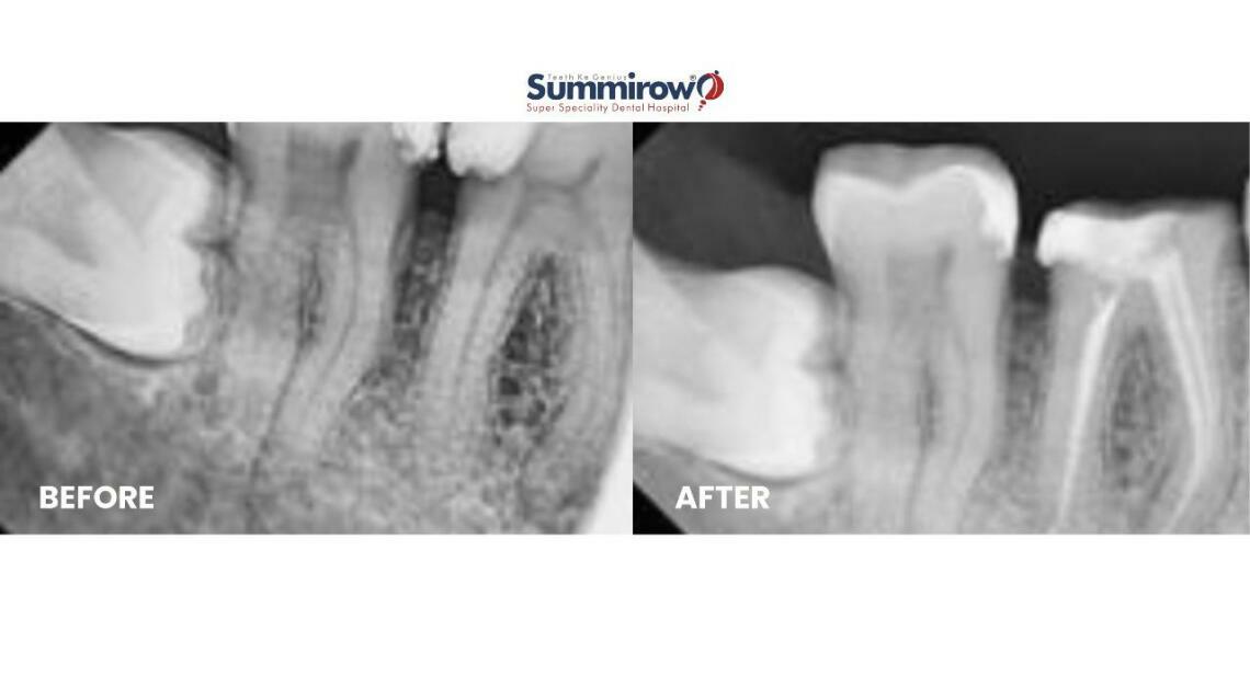 From Composite Filling to Root Canal Treatment and Crown in Tooth 46