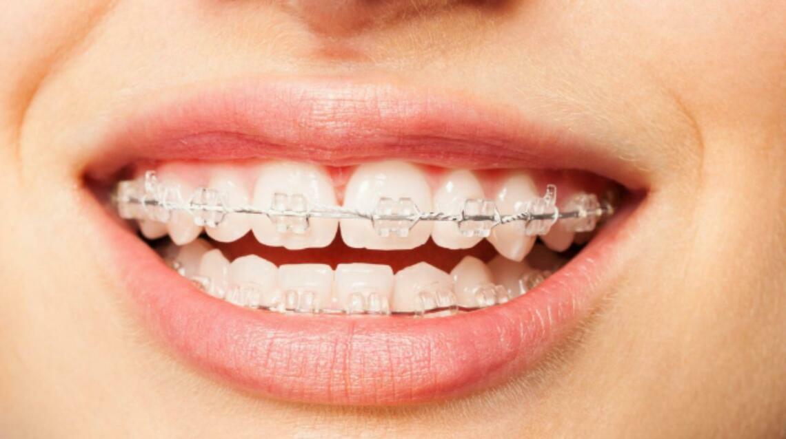 Everything You Need to Know About Braces