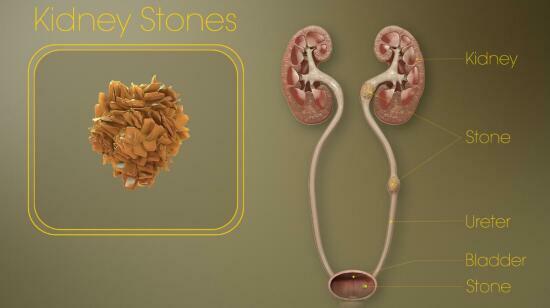 Kidney & Bladder Stone