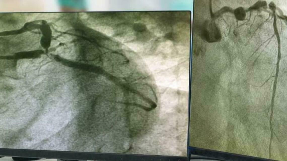 What Is Angiography and Is It a Risky Procedure?