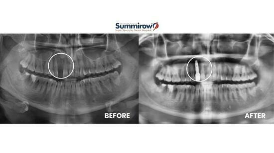 Implant Placement With Crown in Missing Lateral Incisor (Tooth 12)