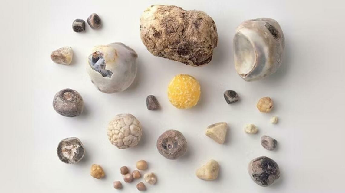 Bladder Stone - Best Treated by Dr. Dilip Raja Mumbai Bandra West