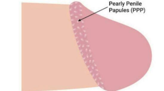 Penile Pearly Papules (Ppp)