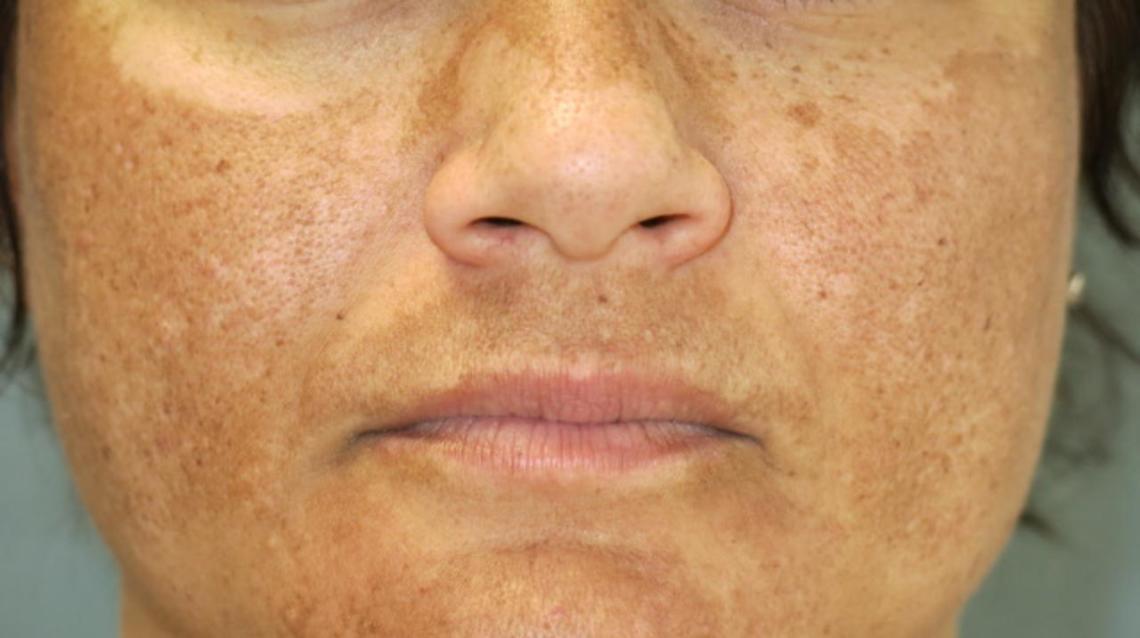 Melasma Prevention And Treatment