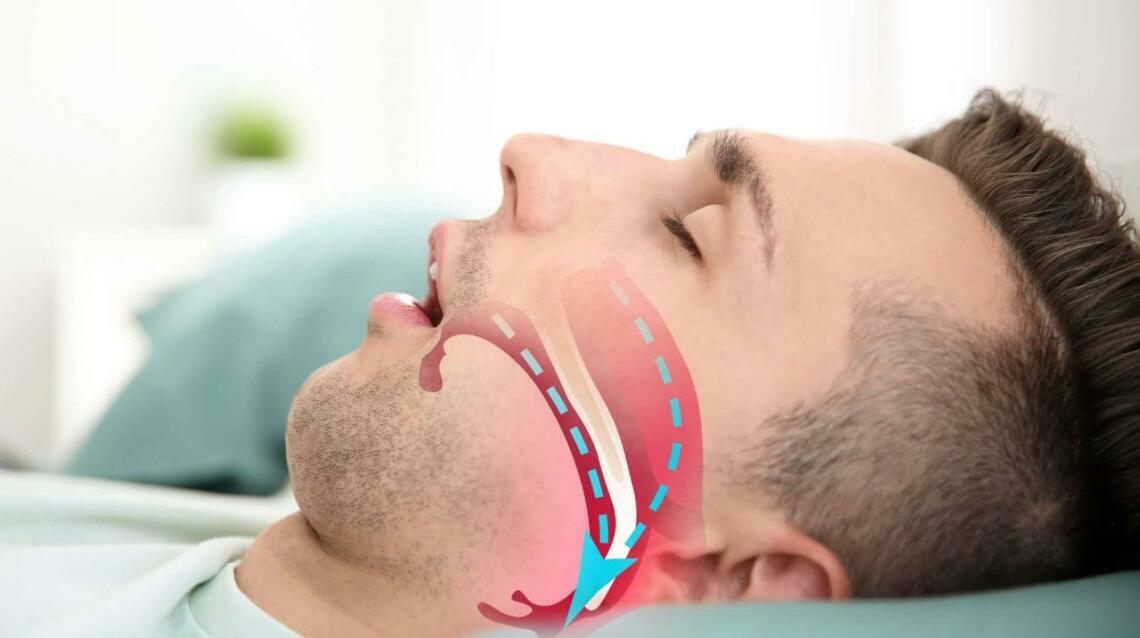 The Link Between Snoring and Sleep Apnea