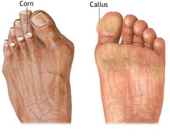 Corn &amp; Callus