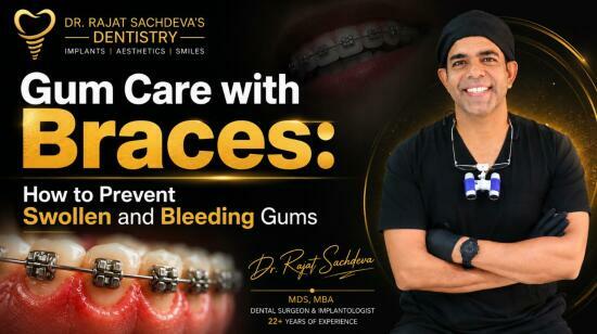 Gum Care With Braces: How to Prevent Swollen and Bleeding Gums by Dr. Rajat Sachdeva, Mds, Mba