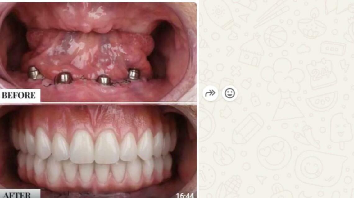 Full Mouth Rehabilitation With Dental Implants at Olivegreen Dental Clinic, Vaishali Nagar