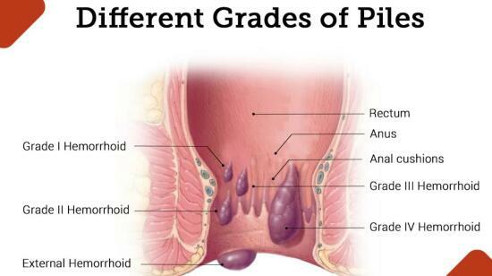 Haemorrhoids or Piles