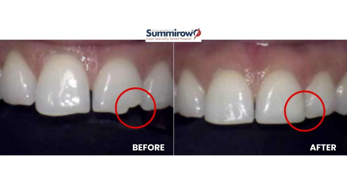 Minimally Invasive Smile Makeover Procedures: Quick, Low-Downtime Options for Visible Improvements