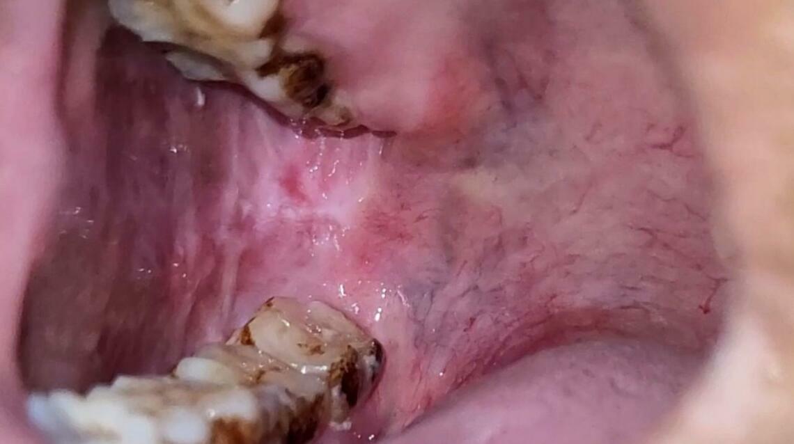 Are You Facing Burning Sensation Mouth? Rule Out Osf.