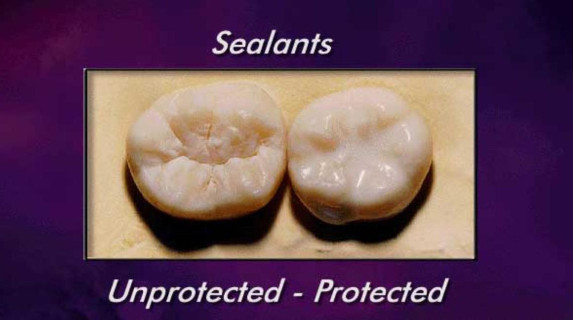 Prevent Dental Cavities Try Sealants