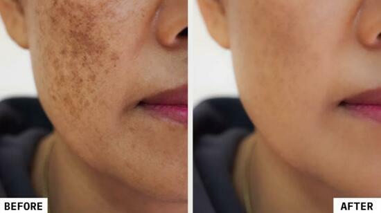 "From Pigmentation to Perfection: Q-Switch Laser Treatment Only at Radiance Clinics, Bhubaneswar"