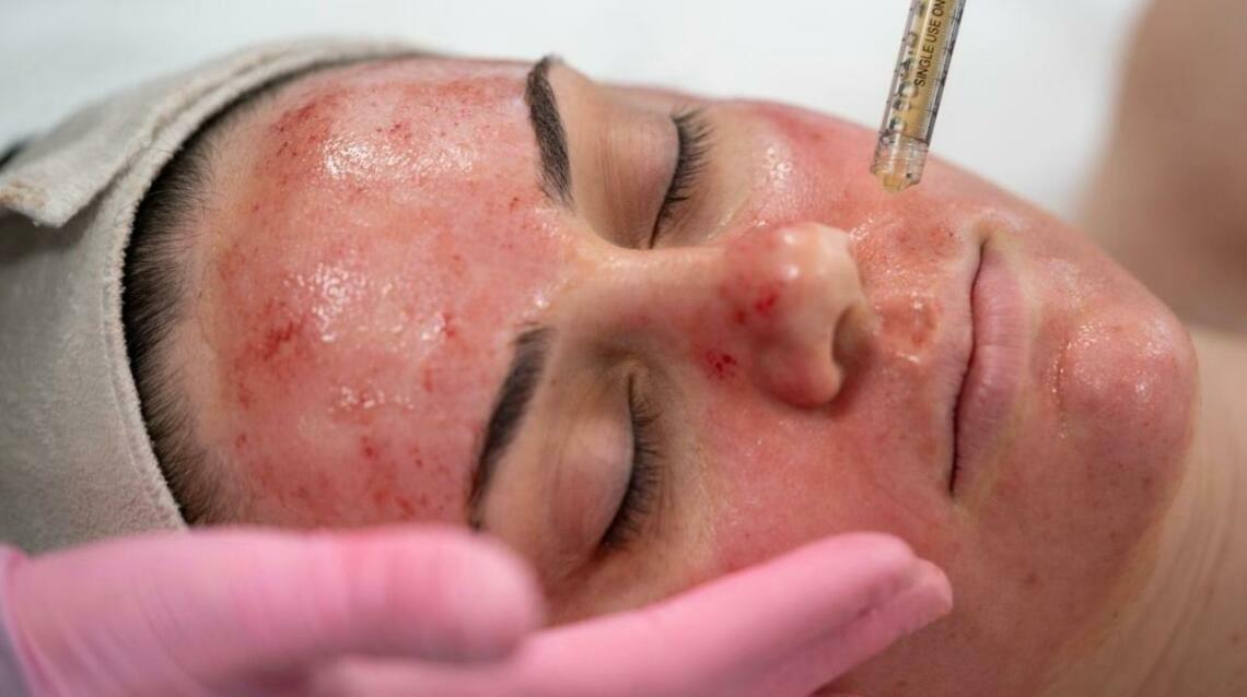 All You Need to Know About : Vampire Facials