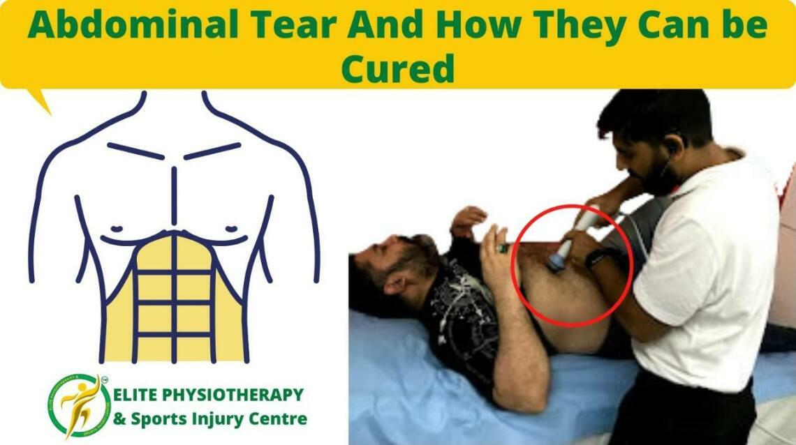 Abdominal Tear and How They Can Be Cured