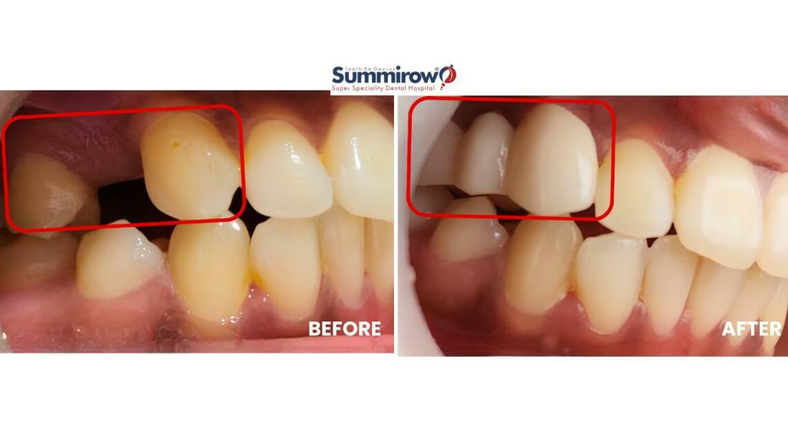Restoring Confidence With a Zirconia Bridge at Summirow Dental Hospital