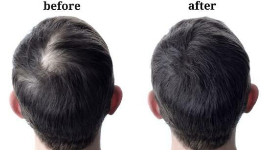 Discover the Power of Exosome Hair Treatment in Bhubaneswar at Radiance Skin & Hair Clinic