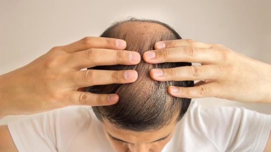 What Does Healthy Hair Mean? Baldness Patterns in Men and Women