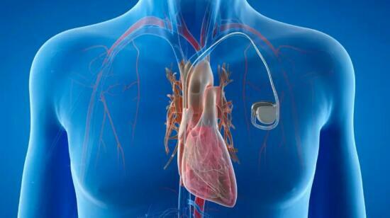 How a Pacemaker Can Improve Your Heart Health?