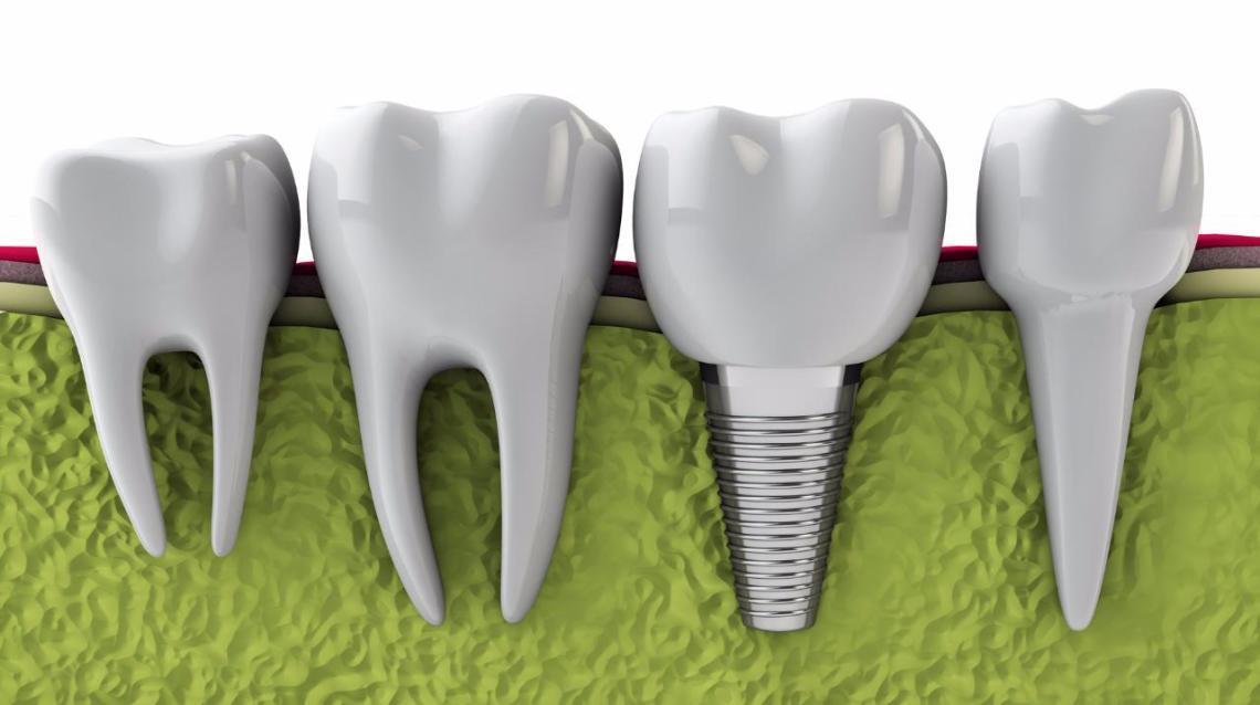 How Safe Are Dental Implants?