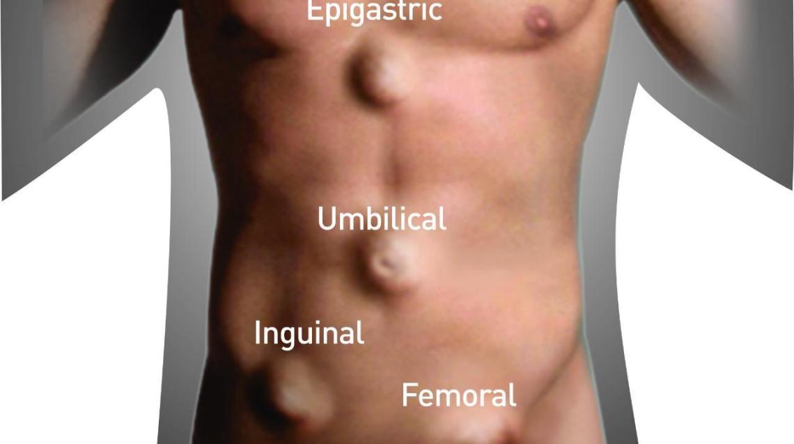 All That You Need to Know About Hernias