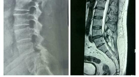 Endoscopic Spinal Fusion for L4–l5 Spondylolisthesis: A Minimally Invasive Success Story