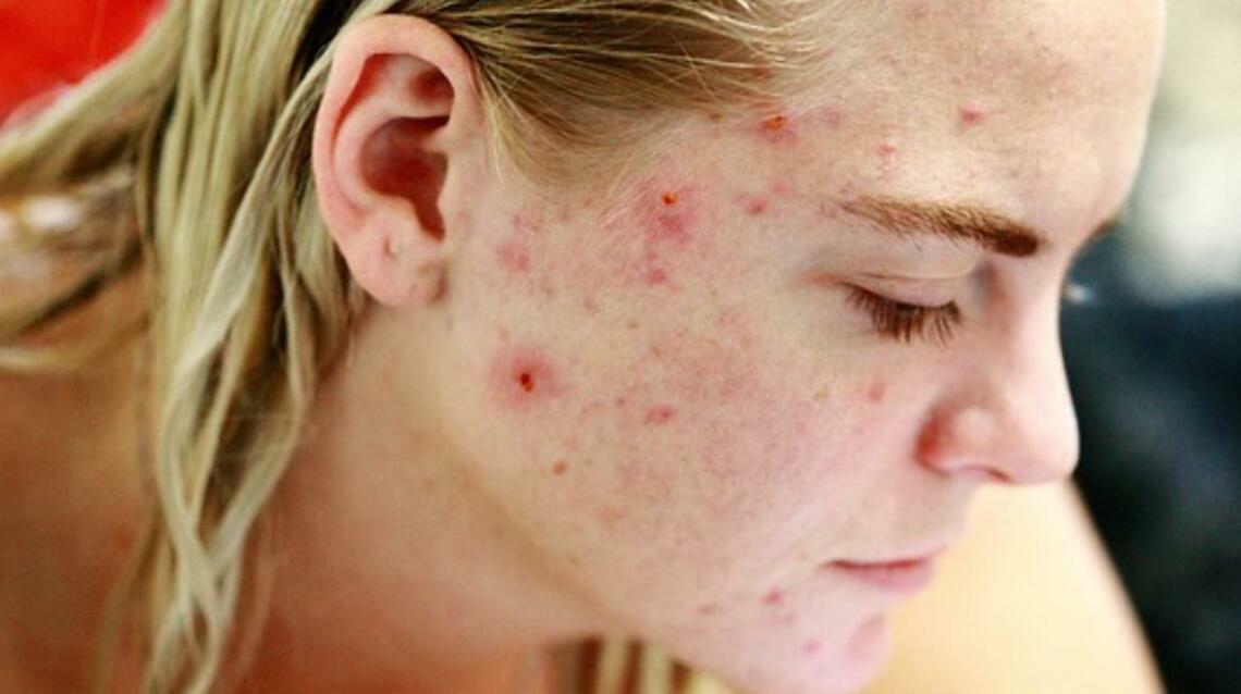 Acne Myths Busted: Common Mistakes That Make Pimple Worse