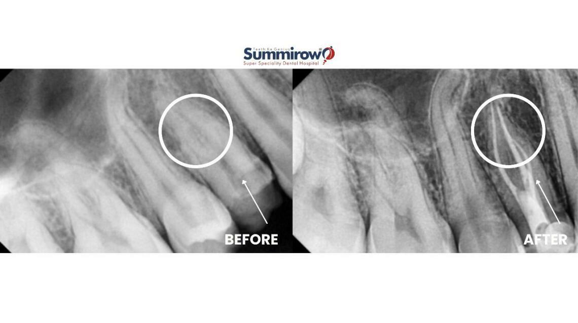 Root Canal Treatment for Painful Lower Right Molar