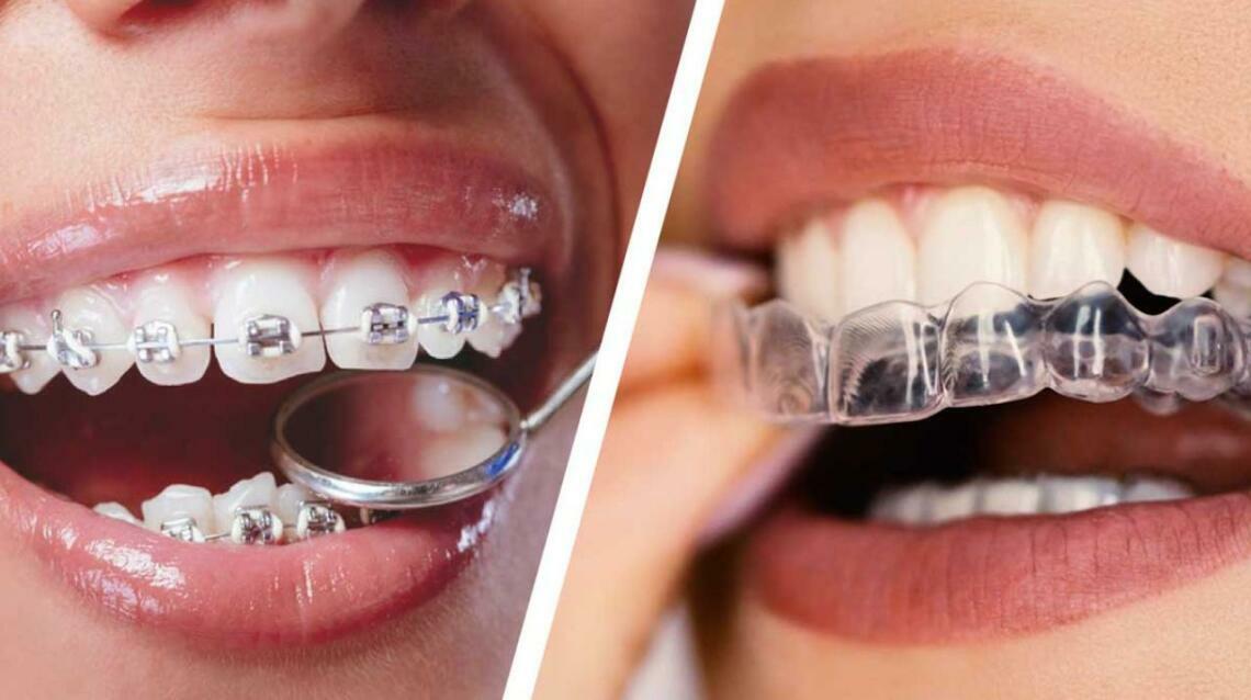Why Orthodontic Treatment Is the Best Choice