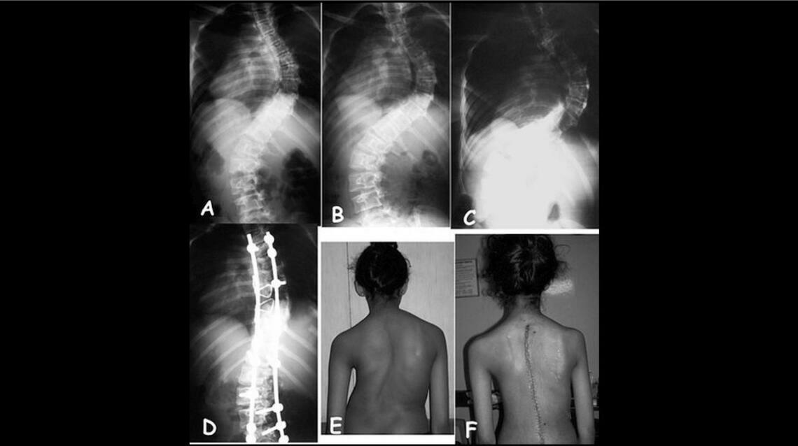 Early Detection->Better Outcomes in Scoliosis and Kyphosis-an Illustrative Case!