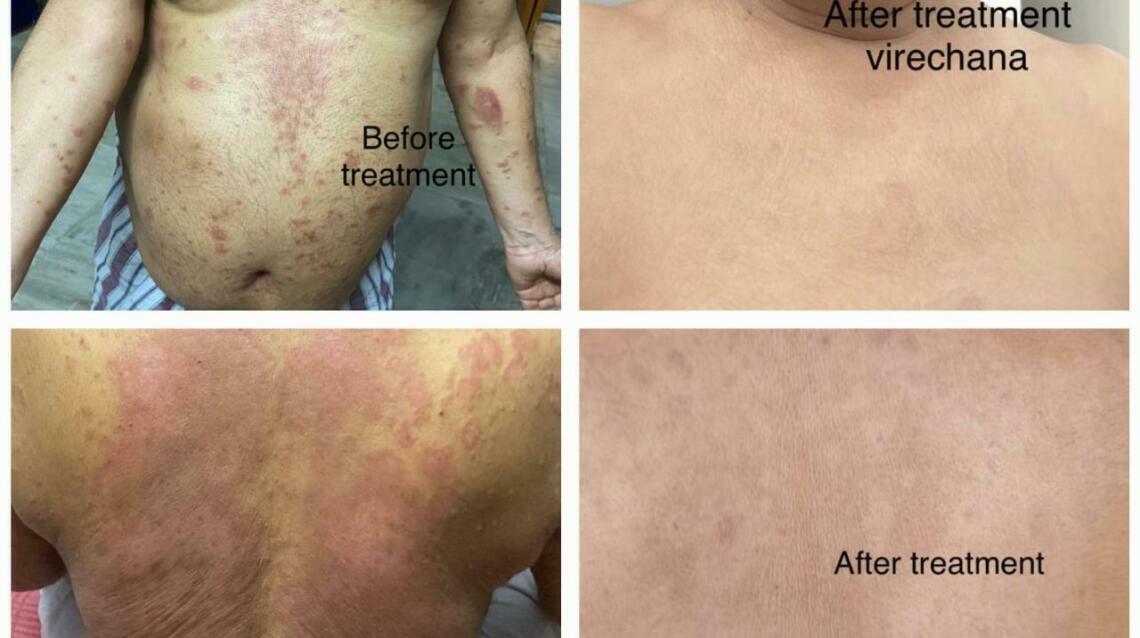 Metabolic Syndrome Linked With Parasitic Scabies.